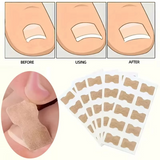 #1 Fungal Nail Patches